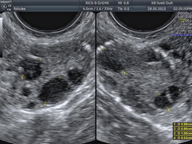 Transvaginal ultrasound showing ovarian follicles with diameter measurements (0.98cm, 0.80cm, 1.00cm, 0.53cm)